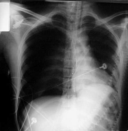 The Lifesaving Potential of 10-Gauge Needles in Treating Life-Threatening Pneumothorax_ A Focus on Combat Medicine